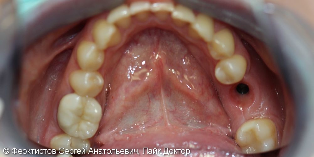Удаление зуба 36 с последующей имплантацией и протезированием, до и после - фото №2