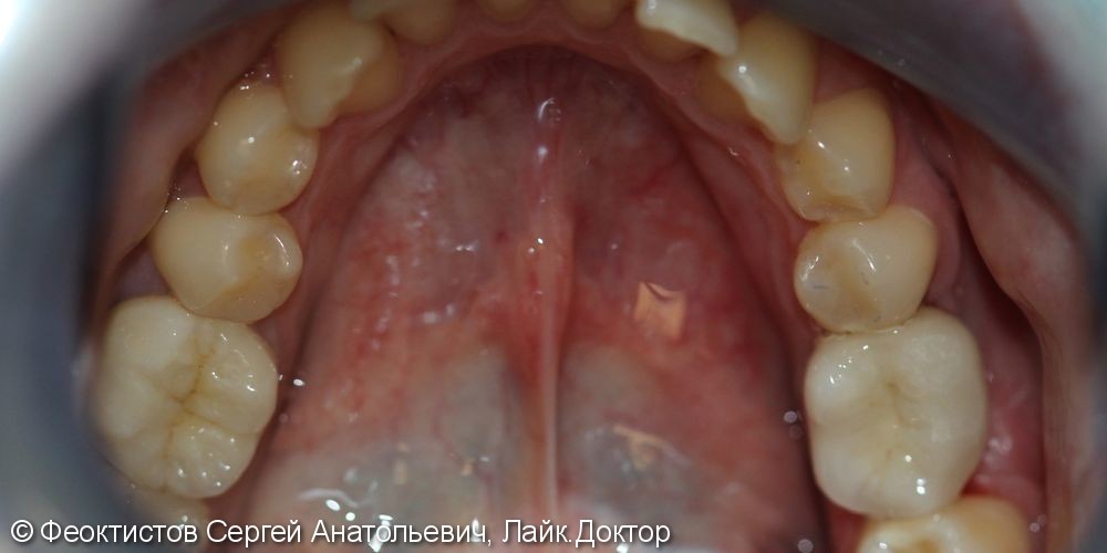Удаление зуба 36 с последующей имплантацией и протезированием, до и после - фото №3