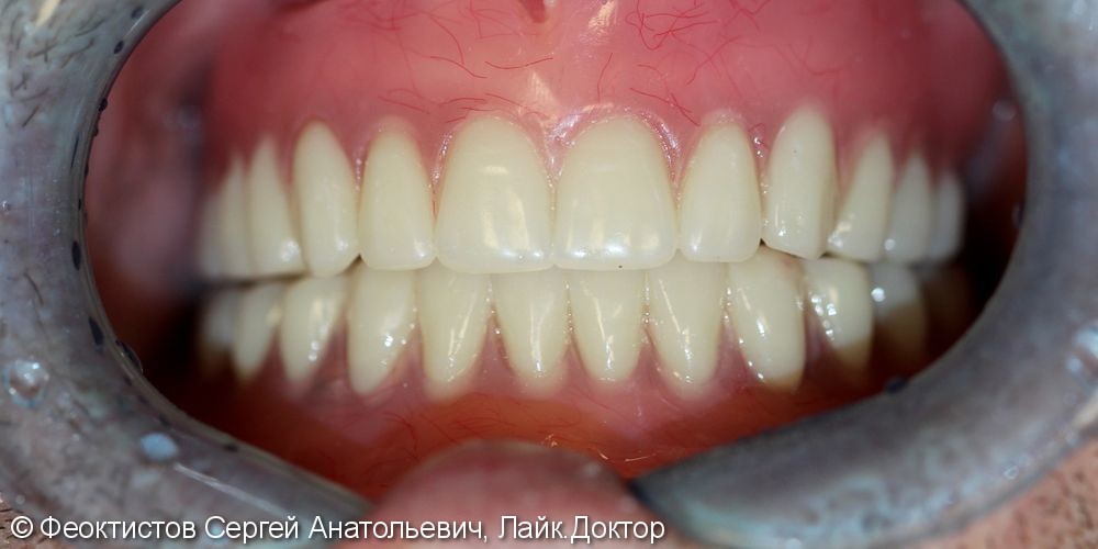 Протезирование при полном отсутствии зубов при помощи имплантатов - фото №4