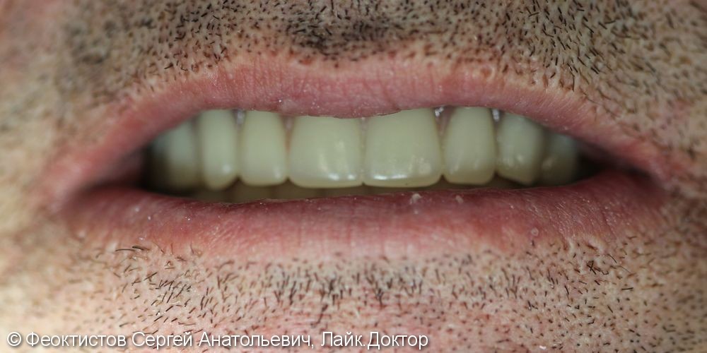 Протезирование при полном отсутствии зубов при помощи имплантатов - фото №3