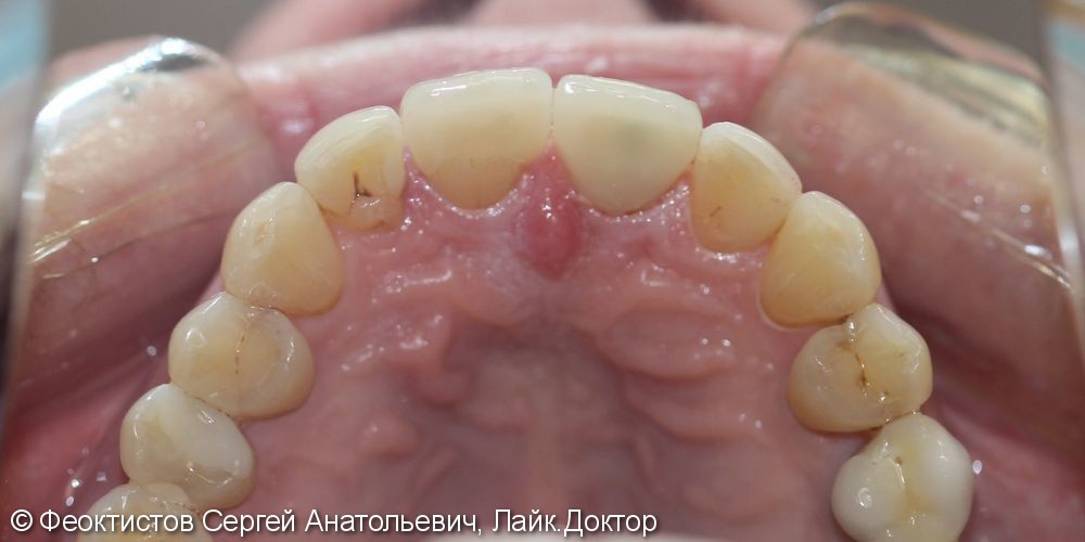 Восстановление 2-х передних зубов керамическими винирами/коронками Е-мах 11, 21 - фото №2