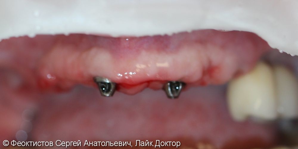 Полное отсутствие зубов, металлокерамический протез на имплантах (all-on-7) - фото №1