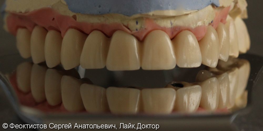 Полное отсутствие зубов, металлокерамический протез на имплантах (all-on-7) - фото №3