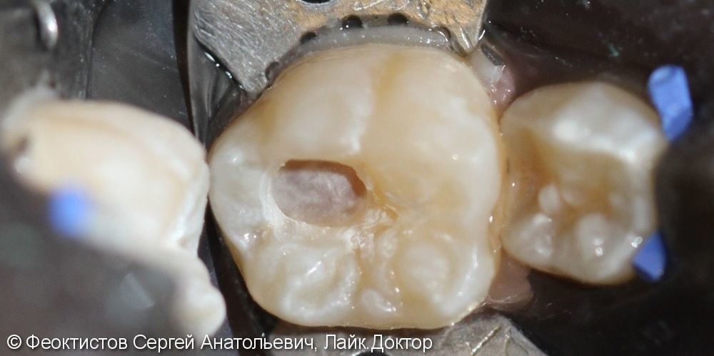 Лечение глубокого кариеса зуба 4.6 - фото №1