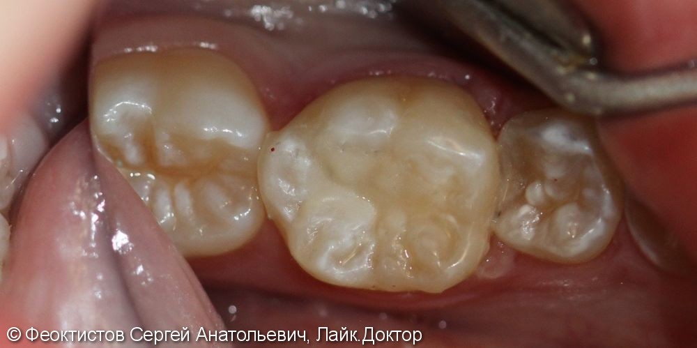 Лечение глубокого кариеса зуба 4.6 - фото №2