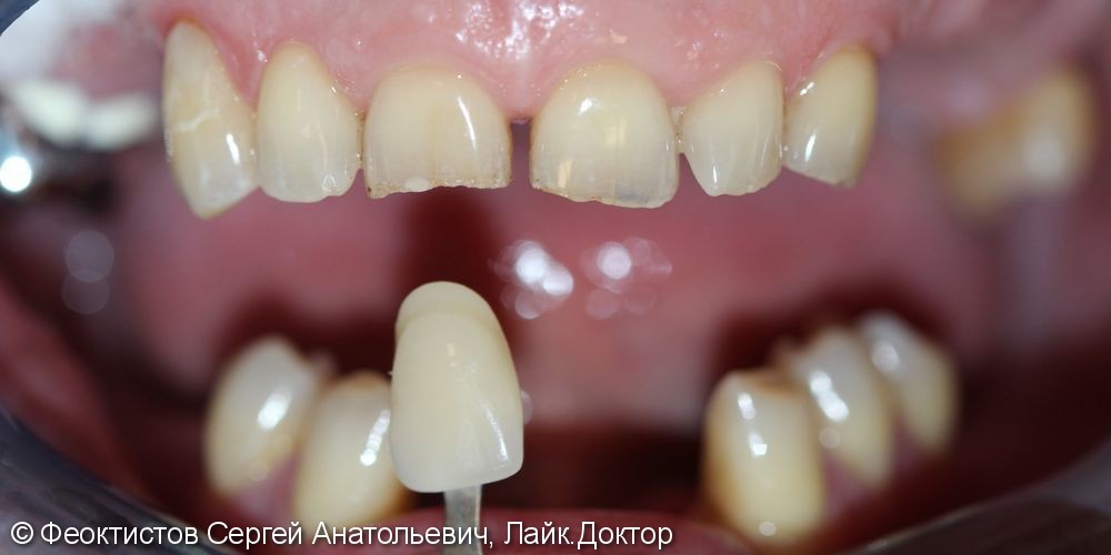 Керамические виниры 13-23, терапевтическая подготовка ( лечение зубов) Бюгельные протезы - фото №1