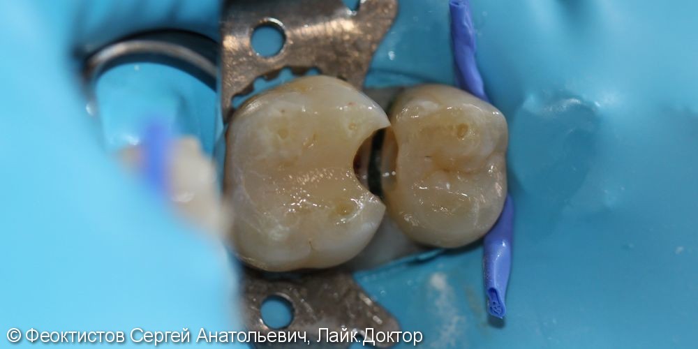 Лечение кариеса жевательных зубов верхней челюсти 1.6 и 1.5 - фото №1