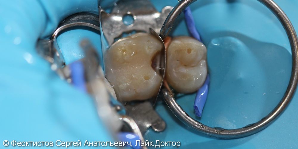Лечение кариеса жевательных зубов верхней челюсти 1.6 и 1.5 - фото №2