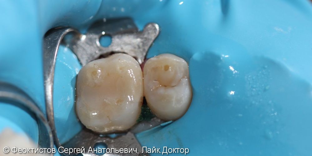 Лечение кариеса жевательных зубов верхней челюсти 1.6 и 1.5 - фото №3