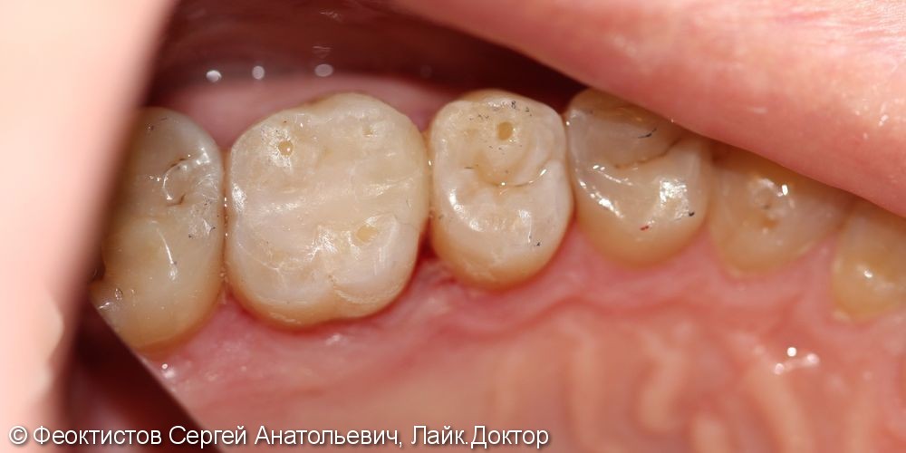 Лечение кариеса жевательных зубов верхней челюсти 1.6 и 1.5 - фото №4