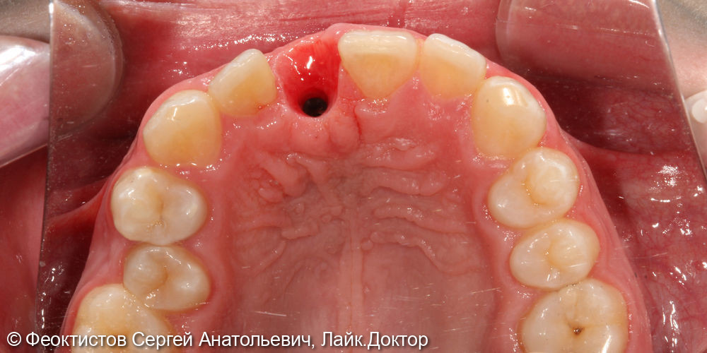 Имплантация в области переднего (центрального) зуба 2.1 - фото №1