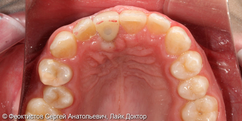 Имплантация в области переднего (центрального) зуба 2.1 - фото №2