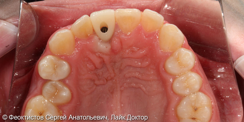 Имплантация в области переднего (центрального) зуба 2.1 - фото №3
