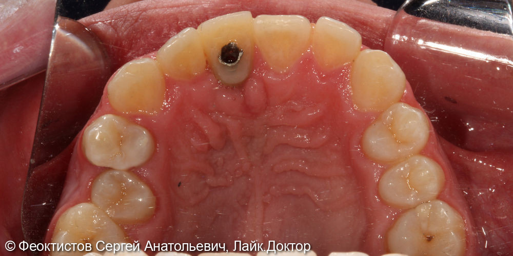 Имплантация в области переднего (центрального) зуба 2.1 - фото №4