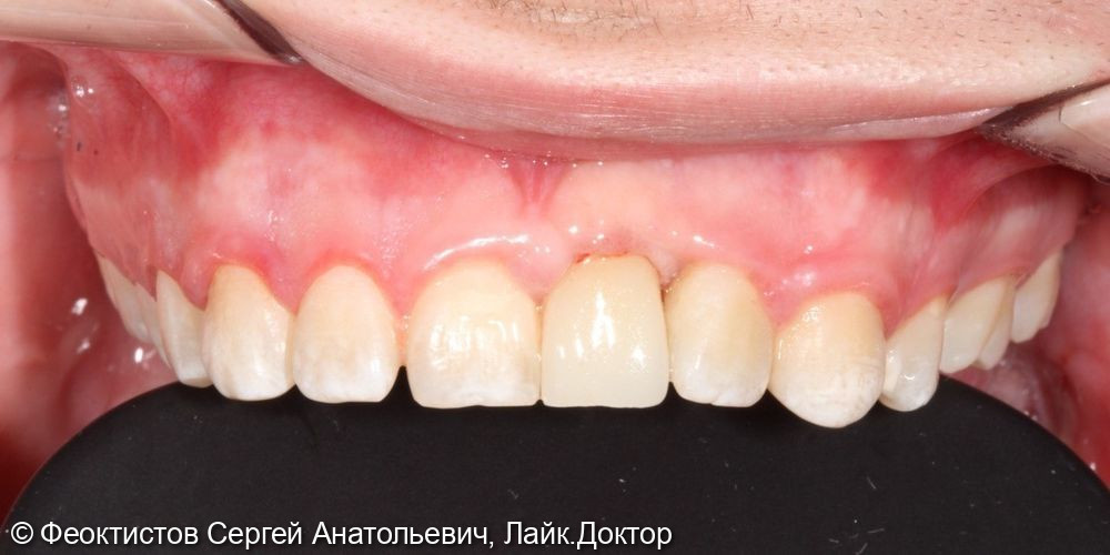 Имплантация в области переднего (центрального) зуба 2.1 - фото №5