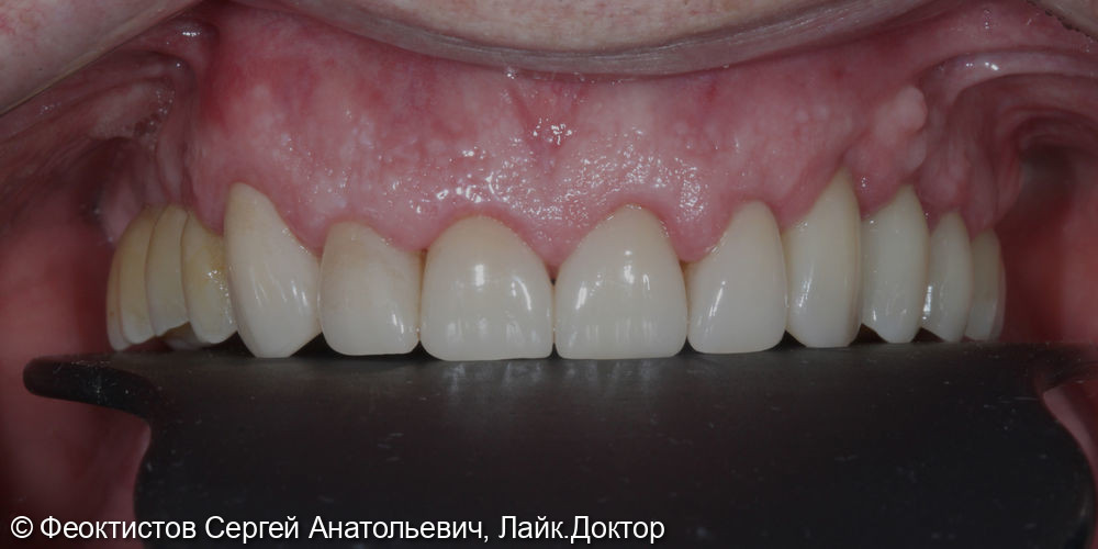 Промежуточный этап тотальной реабилитации на имплантатах и своих зубах - фото №5
