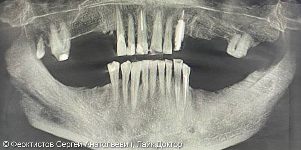 Промежуточный этап тотальной реабилитации на имплантатах и своих зубах - фото №2
