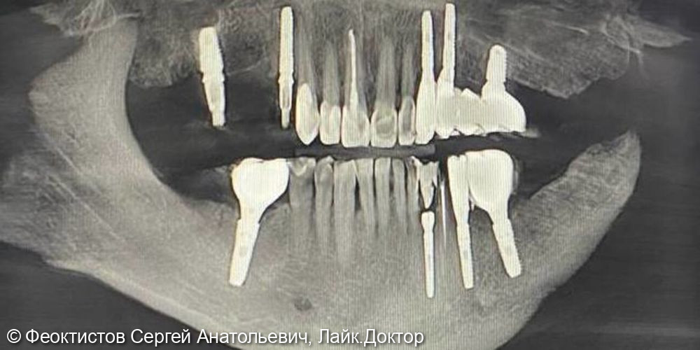Промежуточный этап тотальной реабилитации на имплантатах и своих зубах - фото №3