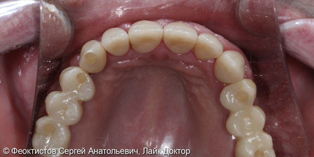 Промежуточный этап тотальной реабилитации на имплантатах и своих зубах - фото №4