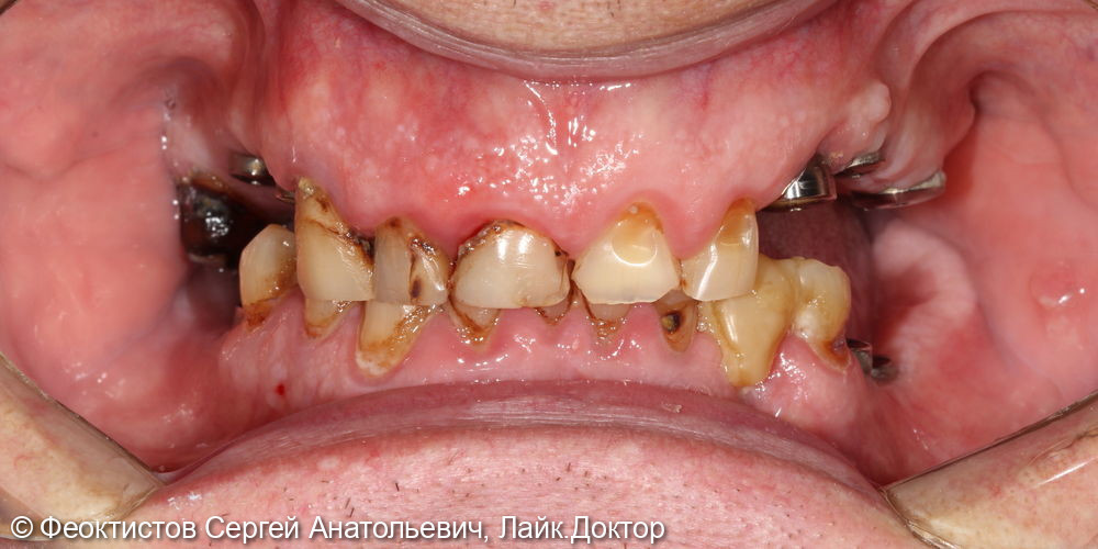 Промежуточный этап тотальной реабилитации на имплантатах и своих зубах - фото №1