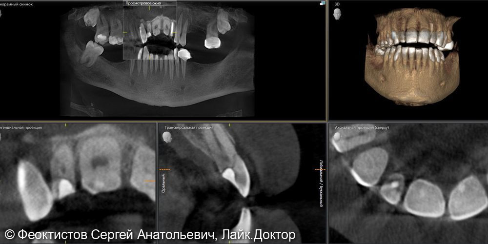 Имплантация - фото №1