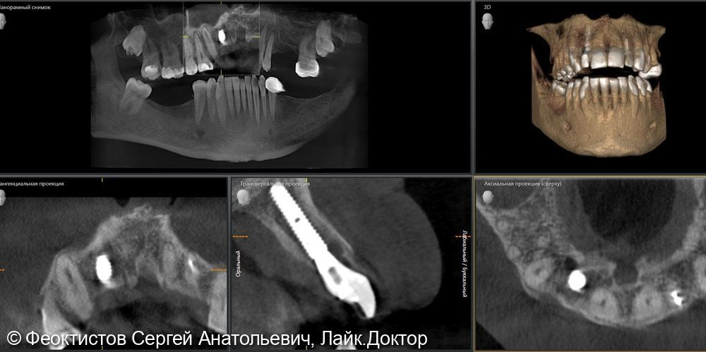Имплантация - фото №5