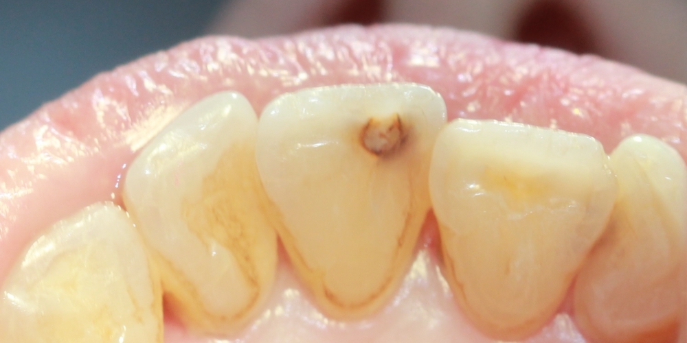 Лечение кариеса переднего зуба (центральный резец) - фото №1