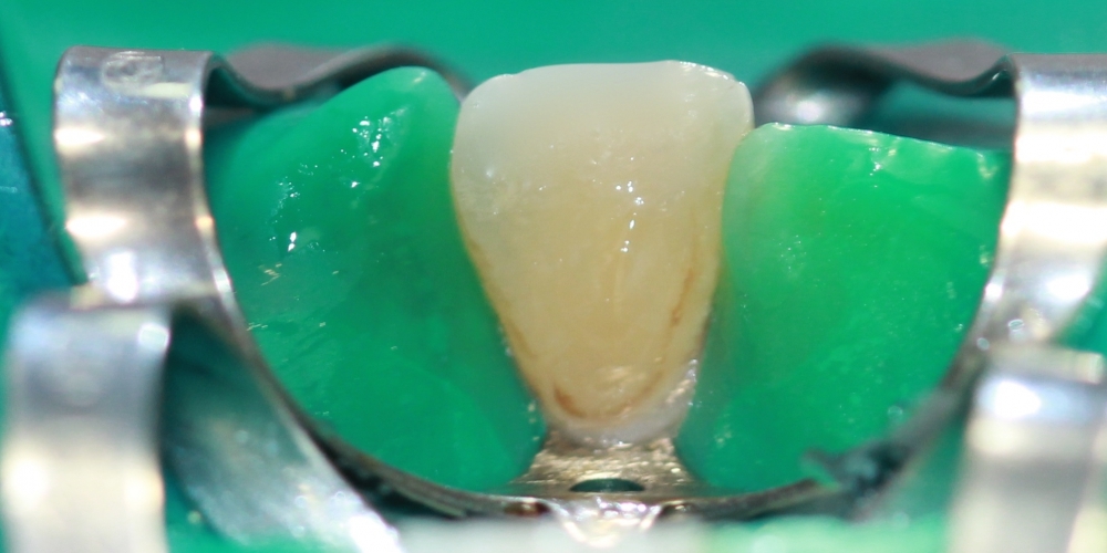 Лечение кариеса переднего зуба (центральный резец) - фото №2