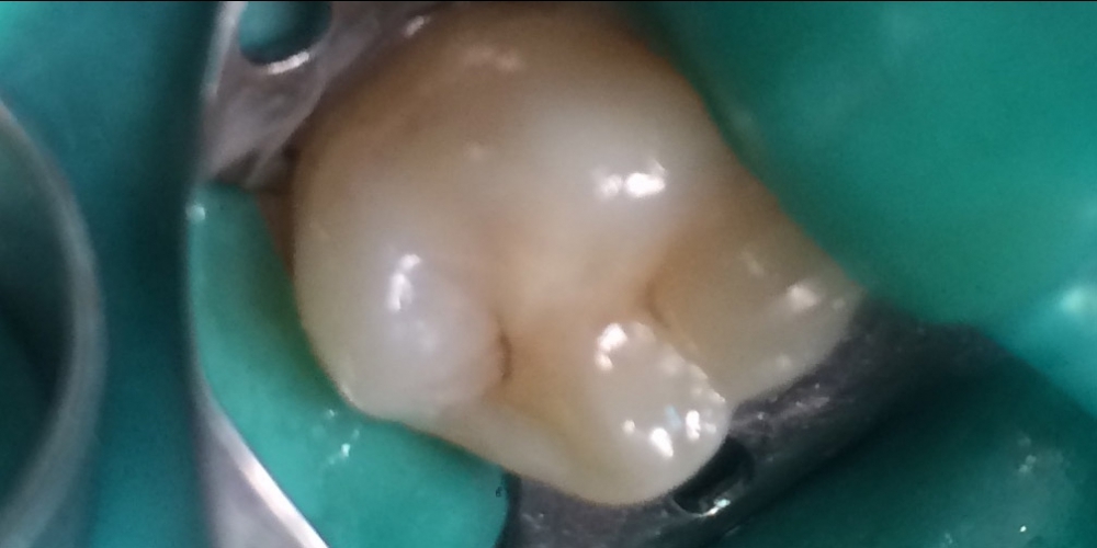 Средний кариес на жевательном зубе верхней челюсти - фото №2
