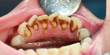Профессиональная чистка зубов ультразвуком с Air-Flow - фото №1