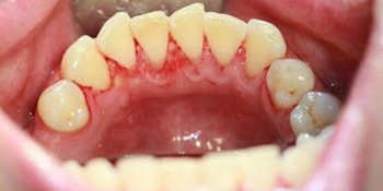 Профессиональная чистка зубов ультразвуком с Air-Flow - фото №2