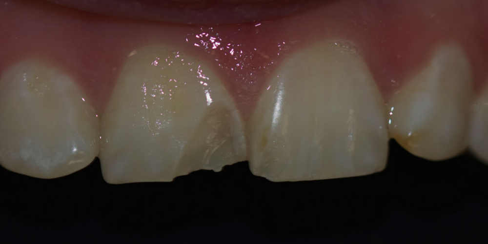 Ремонт скола центрального зуба верхней челюсти - фото №1