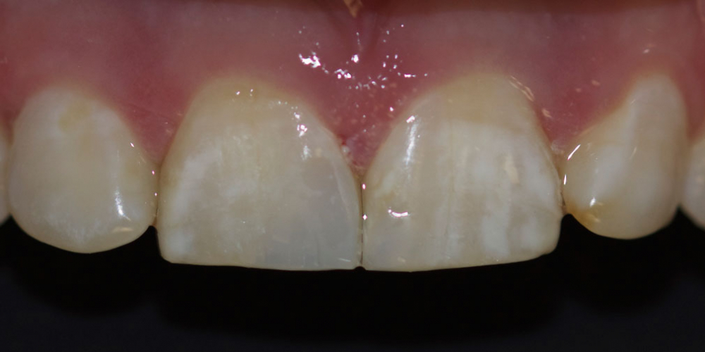 Ремонт скола центрального зуба верхней челюсти - фото №2