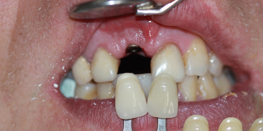 Имплантация переднего зуба и металлокерамическая коронка - фото №1
