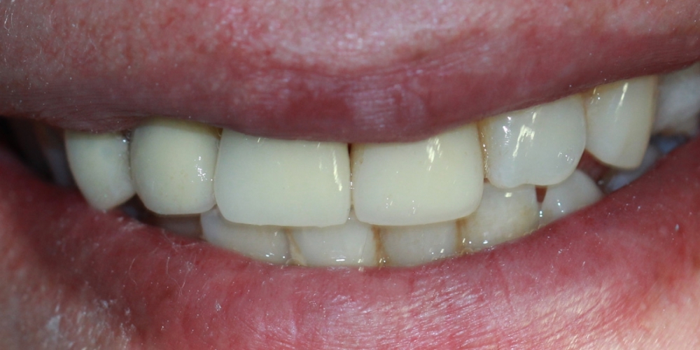 Имплантация переднего зуба и металлокерамическая коронка - фото №2