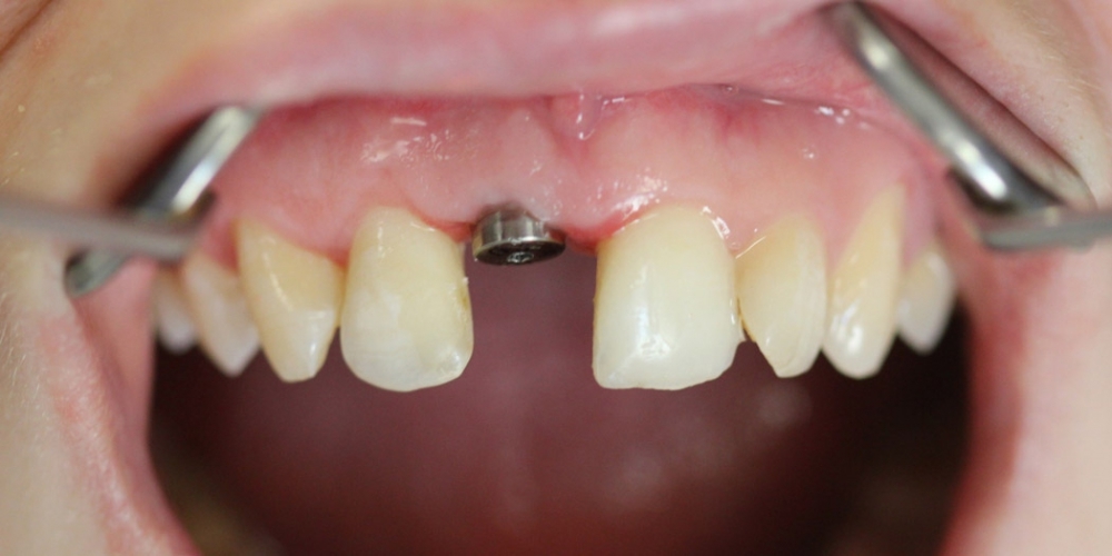 Восстановление переднего зуба имплантатом и коронкой - фото №1