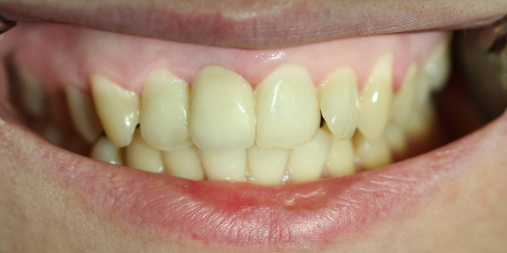 Восстановление переднего зуба имплантатом и коронкой - фото №2