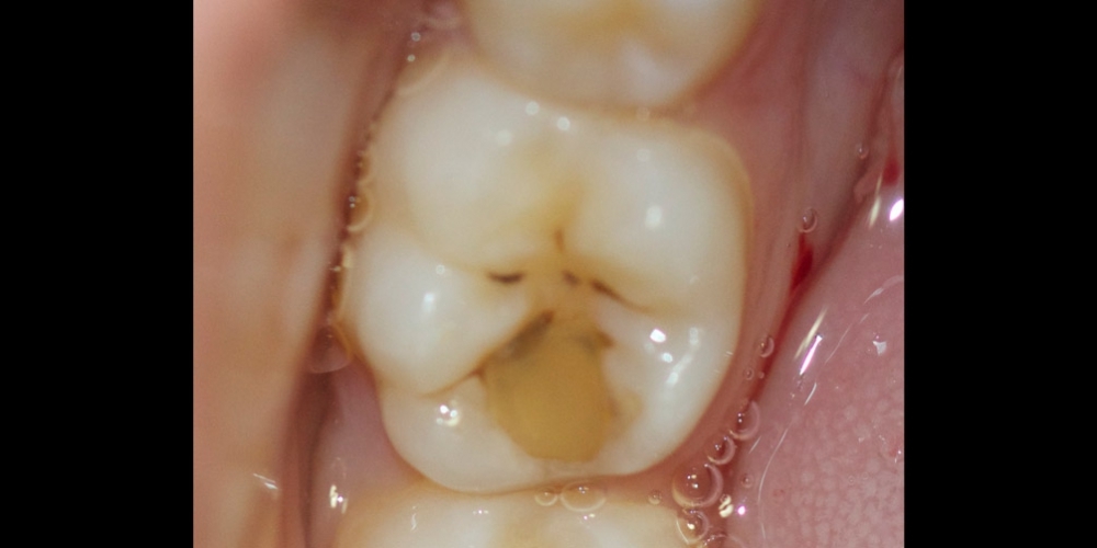 Лечение среднего кариеса на жевательном зубе + реставрация - фото №1