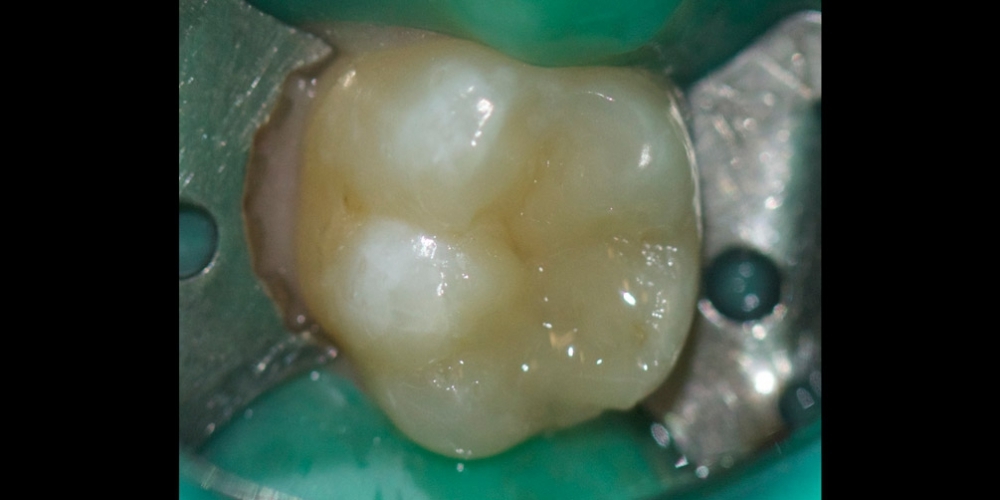 Лечение среднего кариеса на жевательном зубе + реставрация - фото №2