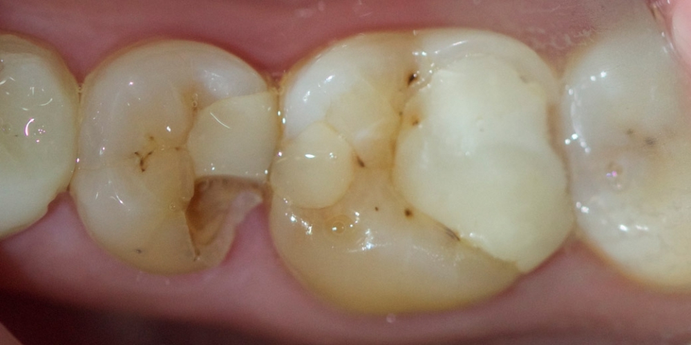 Лечение среднего кариеса на жевательном зубе нижней челюсти - фото №1