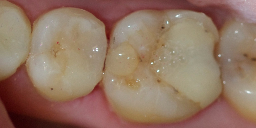 Лечение среднего кариеса на жевательном зубе нижней челюсти - фото №5