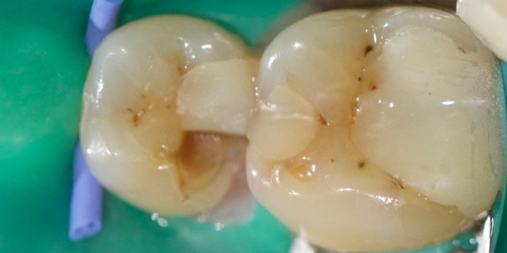 Лечение среднего кариеса на жевательном зубе нижней челюсти - фото №3