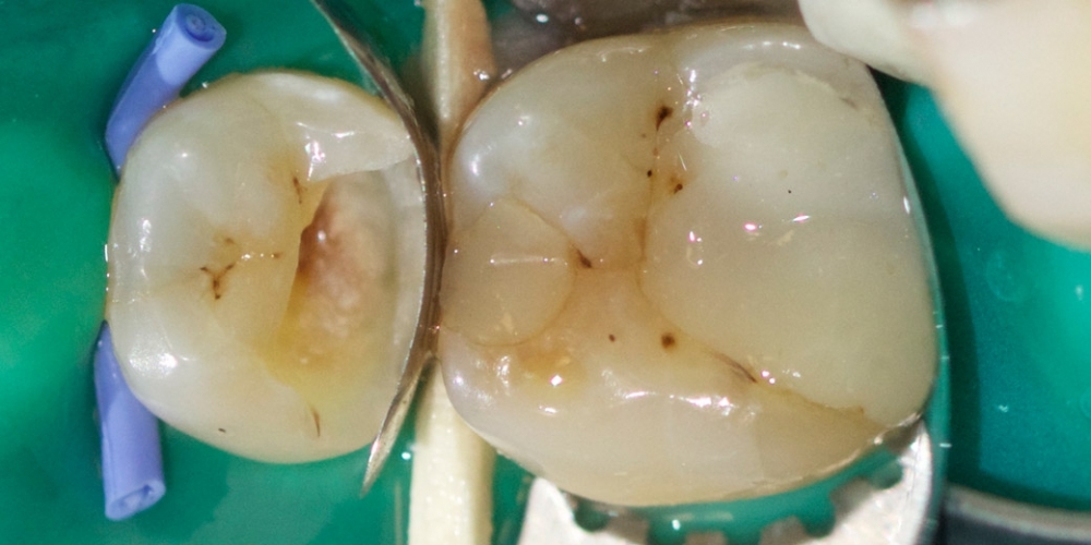 Лечение среднего кариеса на жевательном зубе нижней челюсти - фото №4