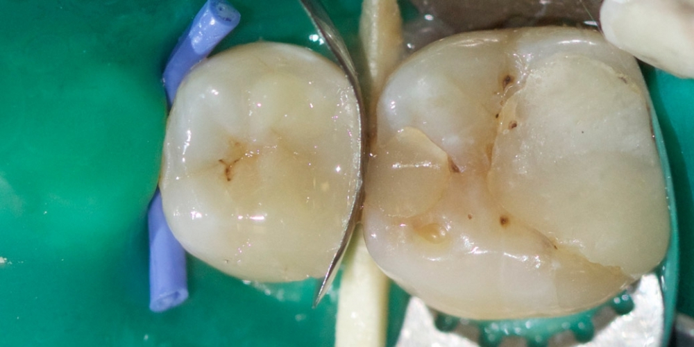 Лечение среднего кариеса на жевательном зубе нижней челюсти - фото №2