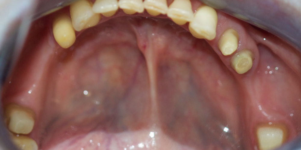 Восстановление жевательной функции зубов на нижней челюсти мостовидными протезами - фото №1