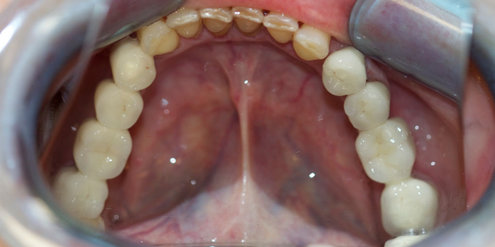 Восстановление жевательной функции зубов на нижней челюсти мостовидными протезами - фото №2