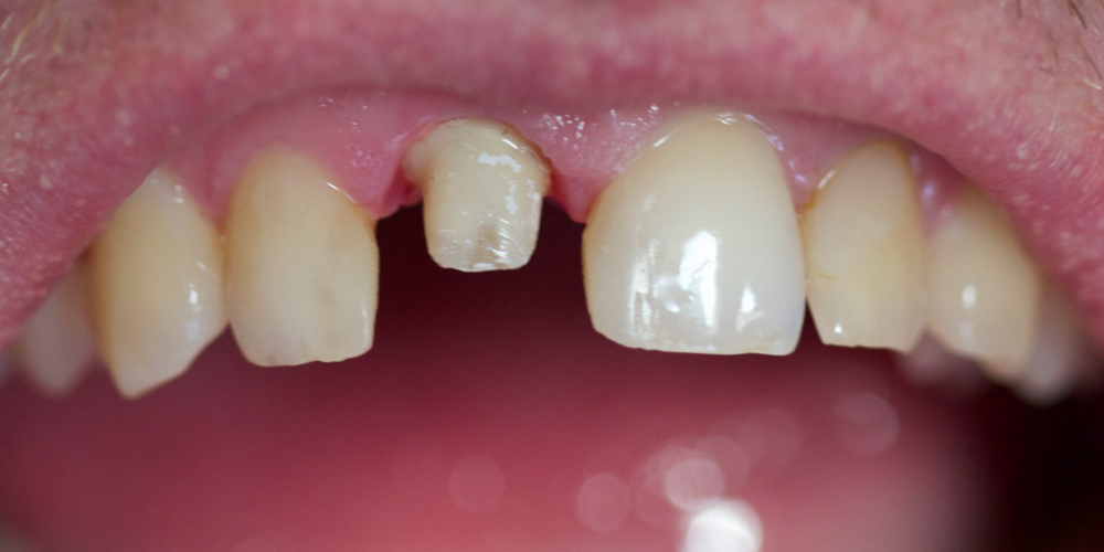 Замена ранее установленной коронки на переднем зубе - фото №1