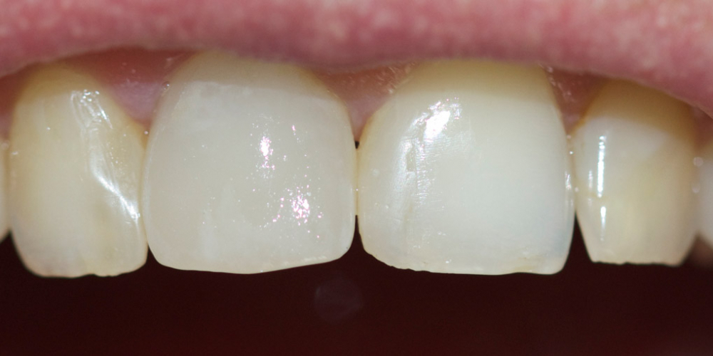 Замена ранее установленной коронки на переднем зубе - фото №3