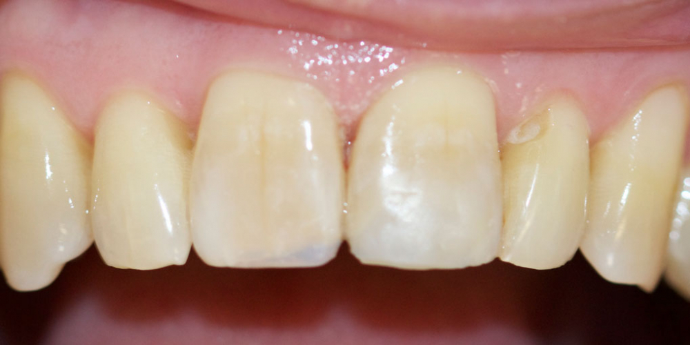Реставрация переднего зуба композитом - фото №2