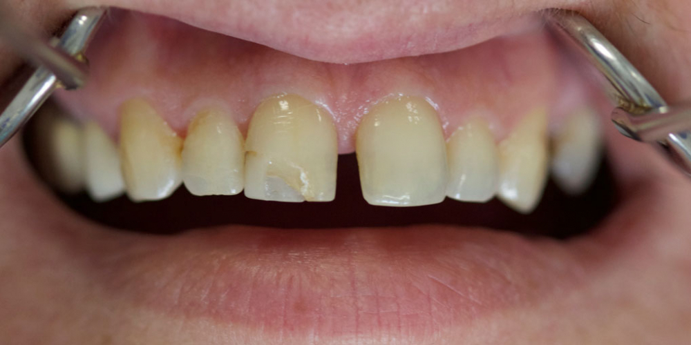 Неудовлетворенность реставрацией на переднем центральном зубе - фото №1